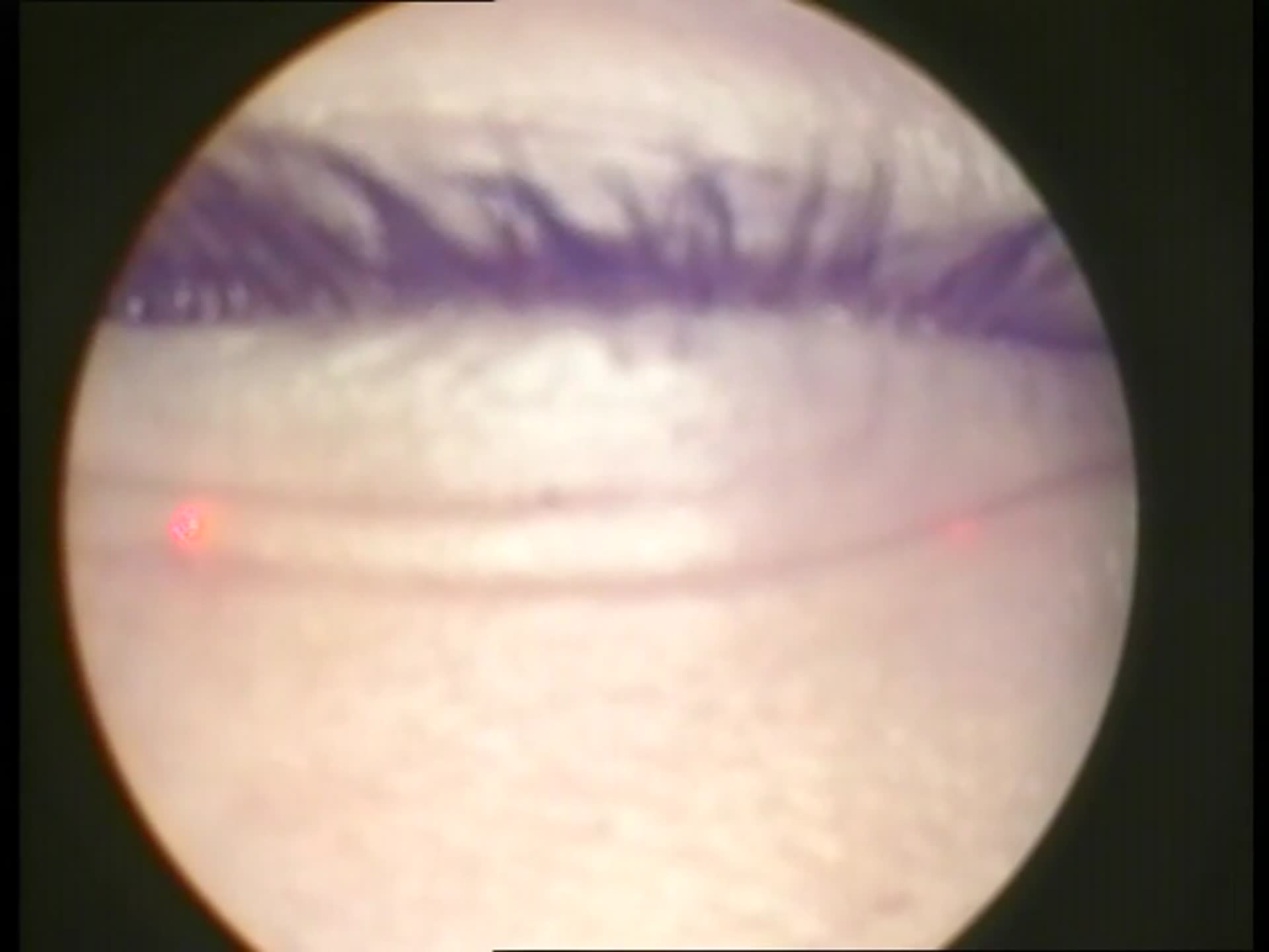 Lasik Augenlaser OP 1 DocCheck