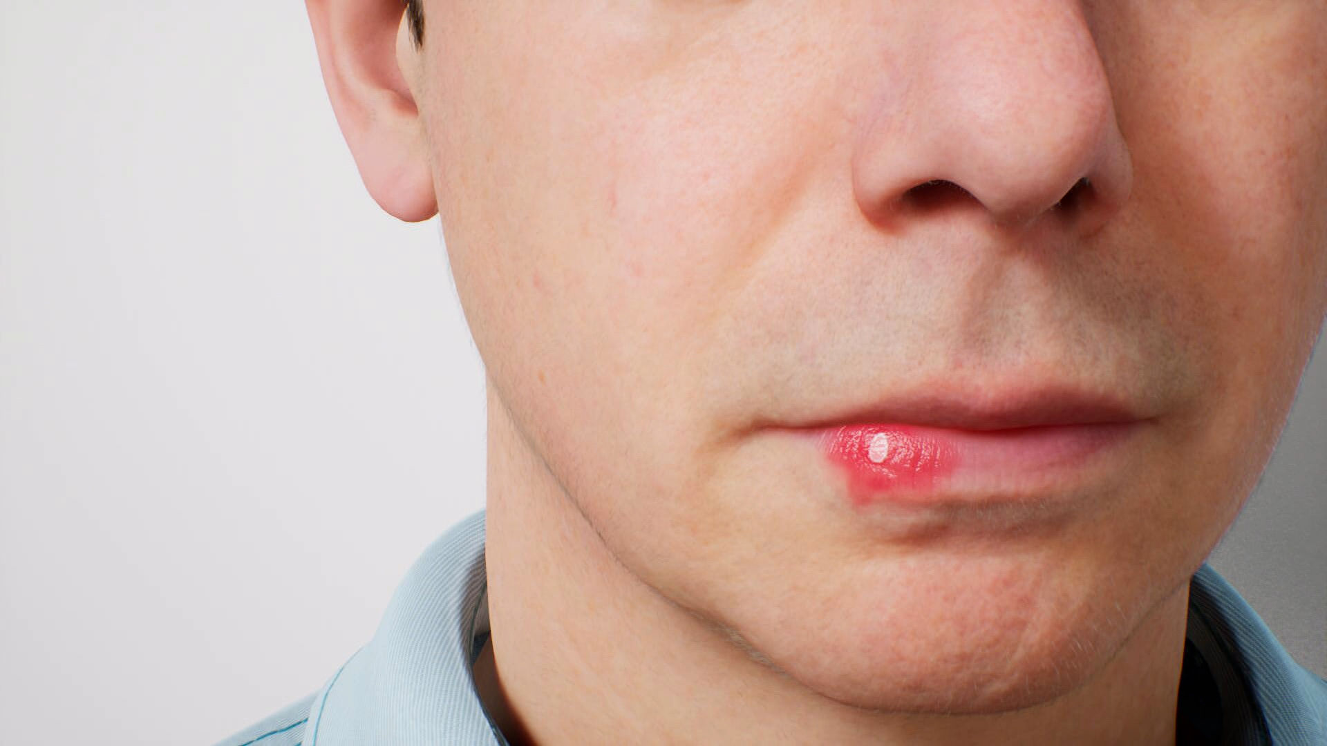 herpes-labialis-symptomverlauf-doccheck
