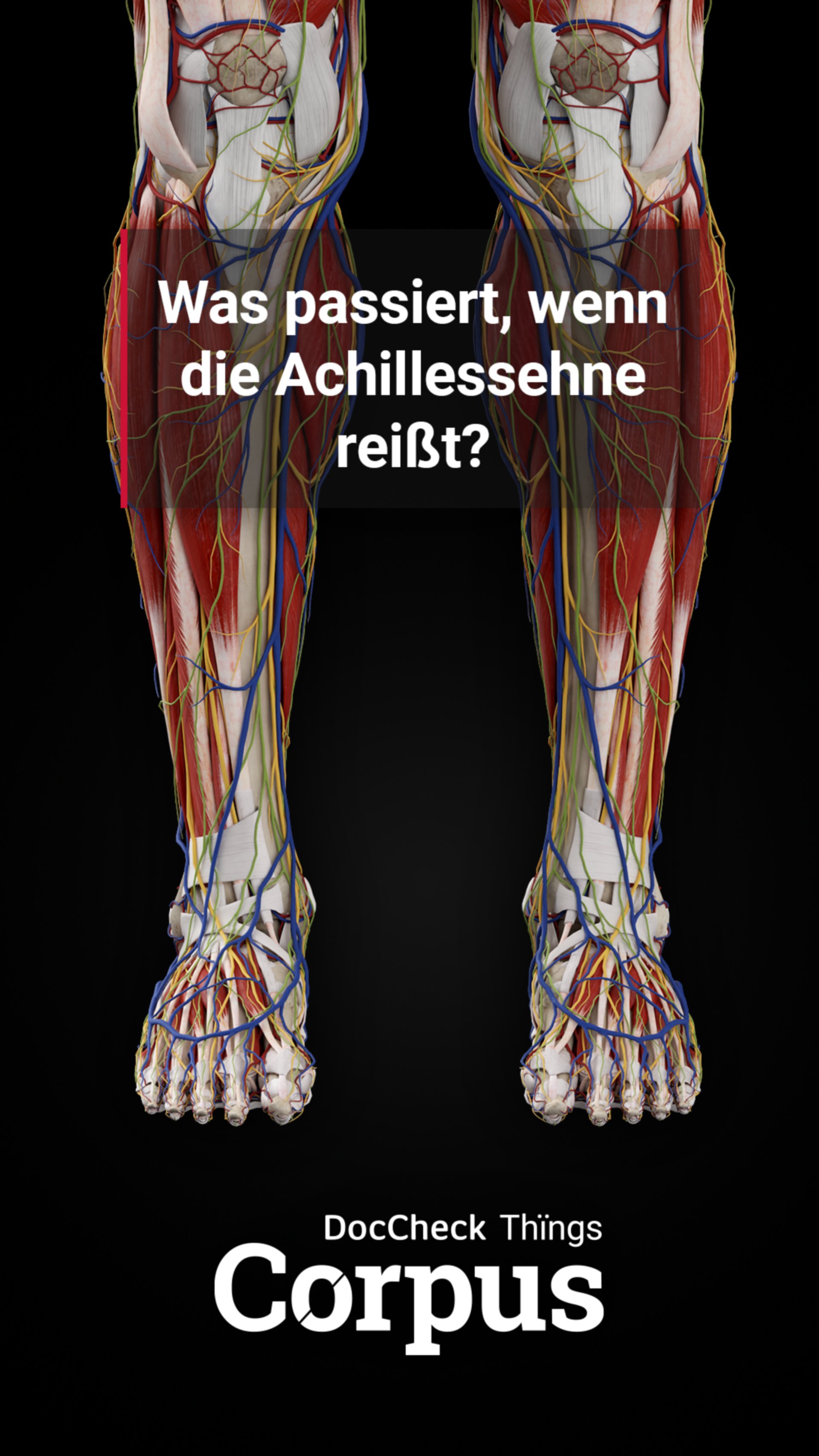 Anatomie zum Anfassen: Achillessehnenruptur - DocCheck