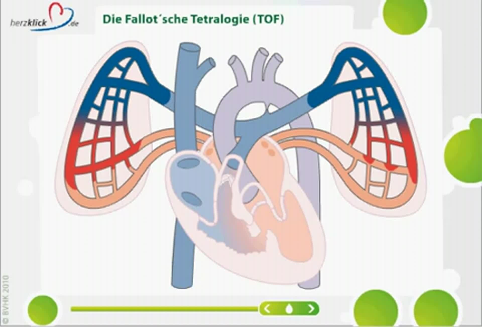 Fallotsche Tetralogie Lebenserwartung Nach Op www.doccheck.com