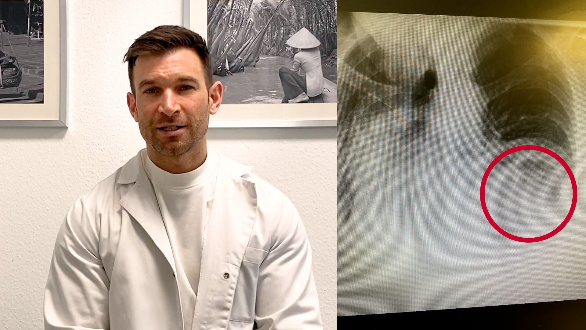 Case Report Enterothorax DocCheck