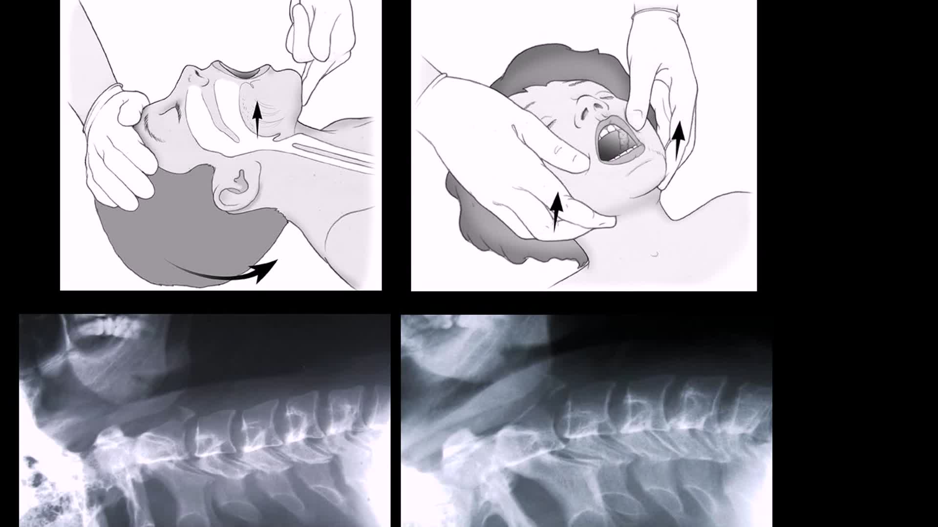 Cervical Spine Protection in Airway Management (not a substitute for