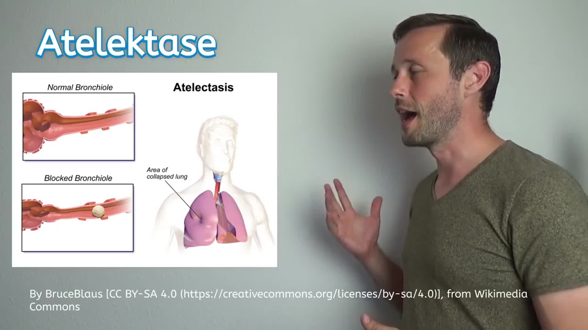 Was ist eine Atelektase? - DocCheck