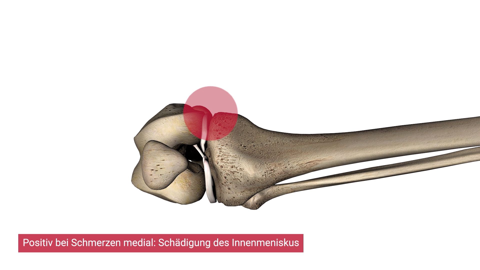 HowTo: Payr-Zeichen (Orthopädie) - DocCheck